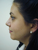 Rhinoplasty (Nasal Surgery)