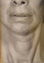 Face and Neck