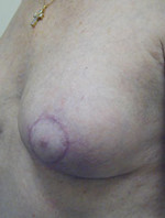 Mastopexy (Breast Lift)