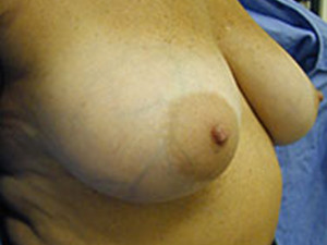 Mastopexy (Breast Lift)