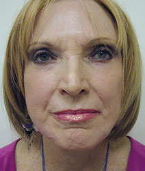 Facial Fillers (Laser)