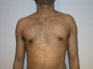 Gynecomastia (Male Breast)