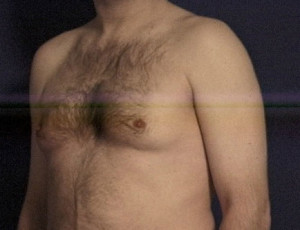 Gynecomastia (Male Breast)